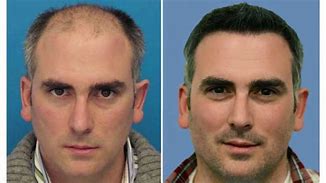 Before/After Results